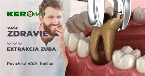 Schéma krvnej zrazeniny v zubnom lôžku po extrakcii
