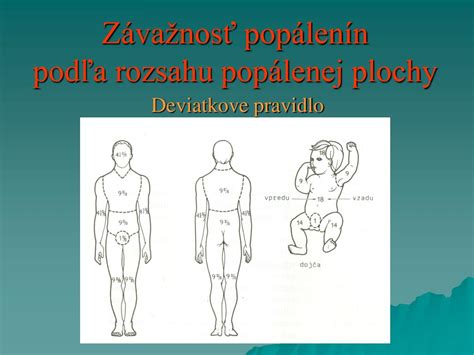 Závažnosť popálenín
