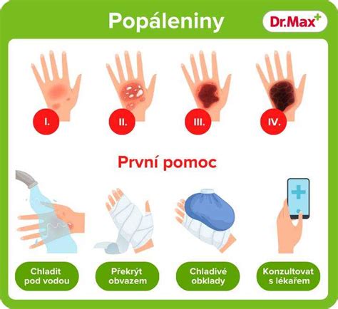 Dôležitosť chladenia pri popáleninách
