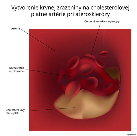 Ilustrácia: Vznik krvnej zrazeniny v cieve