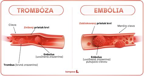 Schéma: Rozdiel medzi venóznou a arteriálnou trombózou