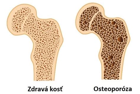 Porovnanie zdravej kosti a kosti postihnutej úbytkom hmoty