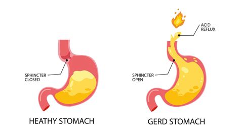Schéma refluxovej choroby pažeráka (GERD)