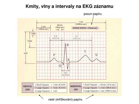 Príklad EKG záznamu s extrasystolou
