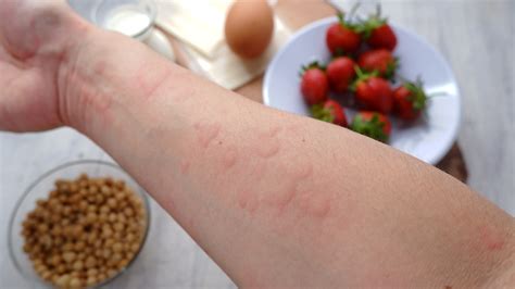 Príznaky alergickej reakcie