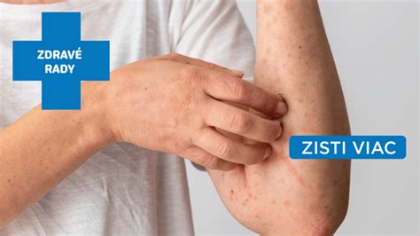 Alergické reakcie na koži