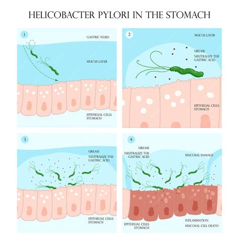 Infografika o baktérii Helicobacter pylori